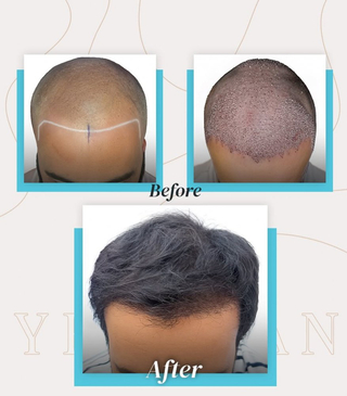 Slider image (4) United Hair Clinic